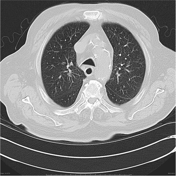 File:Cavitating left lower lobe lesion - squamous cell lung cancer (Radiopaedia 27749-28176 Axial lung window 14).jpg