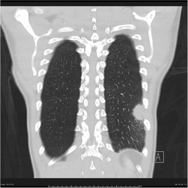 File:Cavitating lung cancer (Radiopaedia 25796-25945 lung window 38).jpg