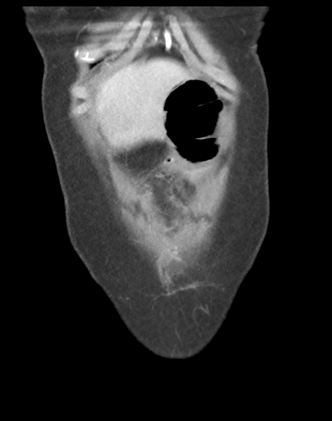 File:Cecum hernia through the foramen of Winslow (Radiopaedia 46634-51112 B 8).png