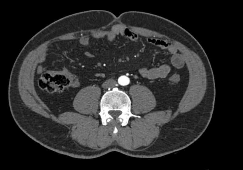 File:Celiac artery dissection (Radiopaedia 52194-58080 A 67).jpg