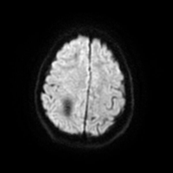 File:Central neurocytoma (Radiopaedia 67618-77021 Axial DWI 18).jpg