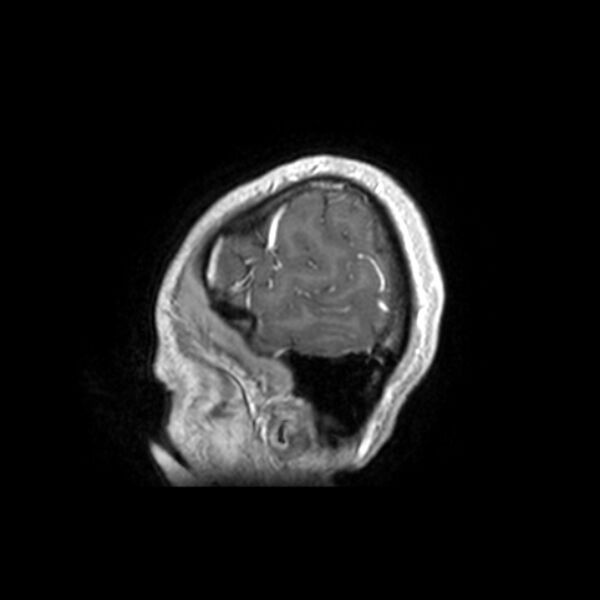 File:Central neurocytoma (Radiopaedia 67618-77021 Sagittal T1 C+ 2).jpg
