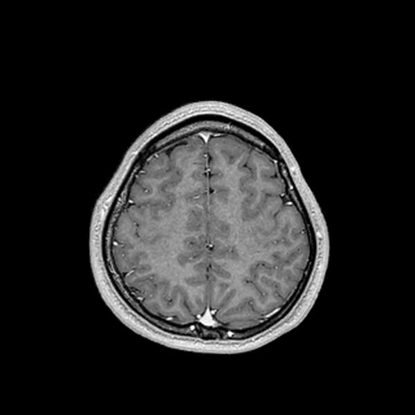 File:Central neurocytoma (Radiopaedia 79320-92380 Axial T1 C+ 188).jpg