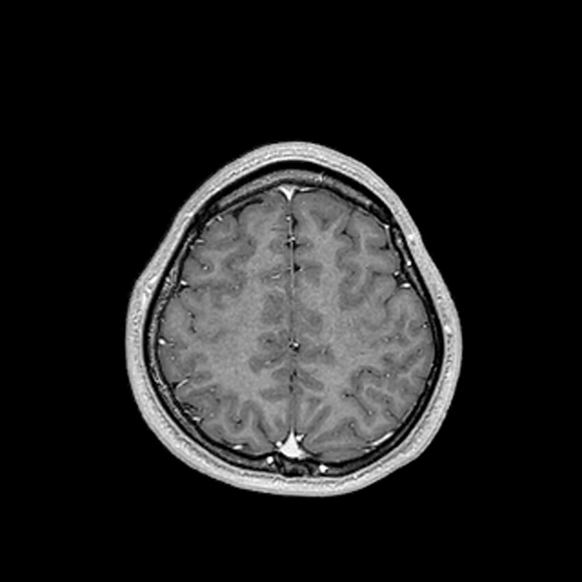 Central neurocytoma (Radiopaedia 79320-92380 Axial T1 C+ 188).jpg