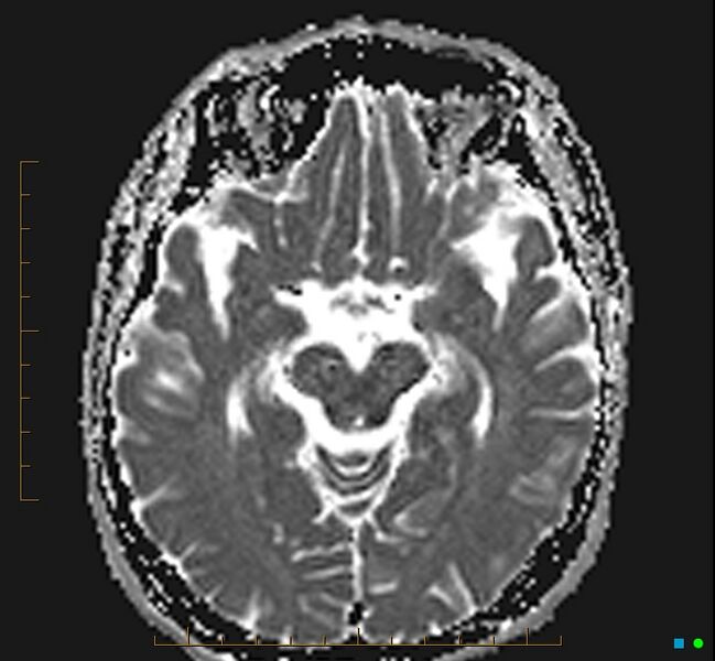 File:Cerebellar gangliocytoma (Radiopaedia 65377-74422 Axial ADC 16).jpg