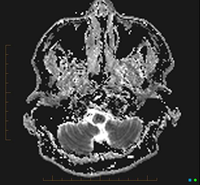 File:Cerebellar gangliocytoma (Radiopaedia 65377-74422 Axial ADC 3).jpg