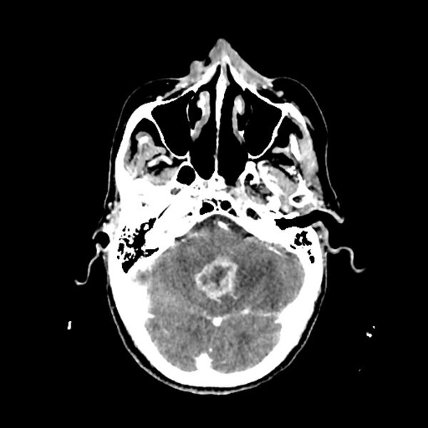 File:Cerebellar metastasis - lung tumor (Radiopaedia 69317-79145 Axial with contrast 11).jpg
