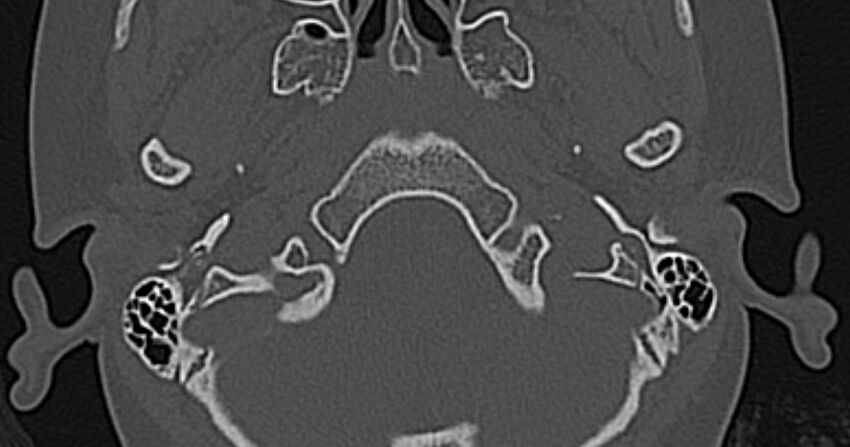 Cerebellopontine angle lipoma (Radiopaedia 57303-64242 Axial bone window 2).jpg