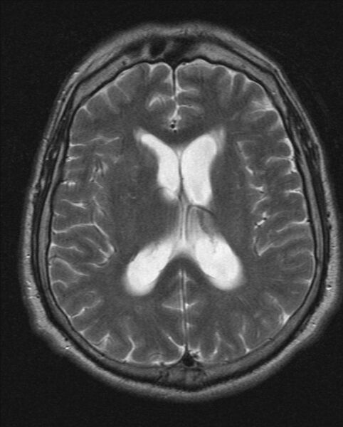File:Cerebellopontine angle meningioma (Radiopaedia 24459-24764 Axial T2 14).jpg