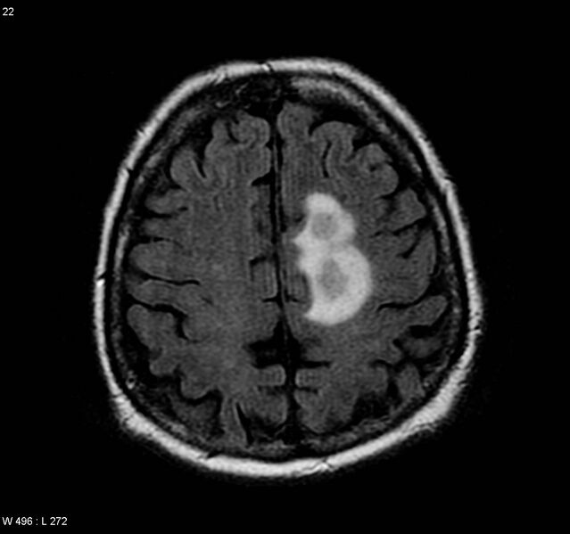 File:Cerebral absceses (Radiopaedia 4933-6838 Axial FLAIR 1).jpg