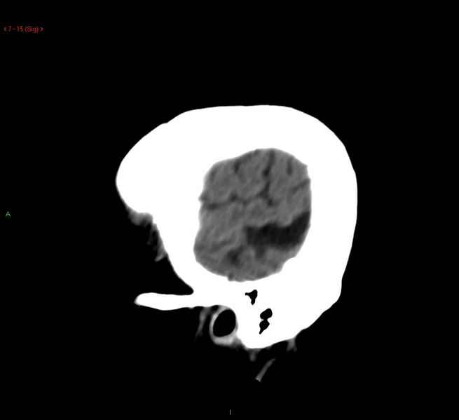 File:Cerebral amyloid angiopathy-associated lobar intracerebral hemorrhage (Radiopaedia 58378-65518 C 15).jpg