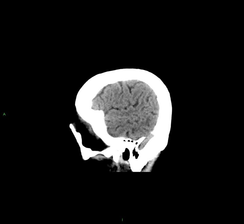 Cerebral amyloid angiopathy-associated lobar intracerebral hemorrhage (Radiopaedia 58529-65681 B 7).jpg