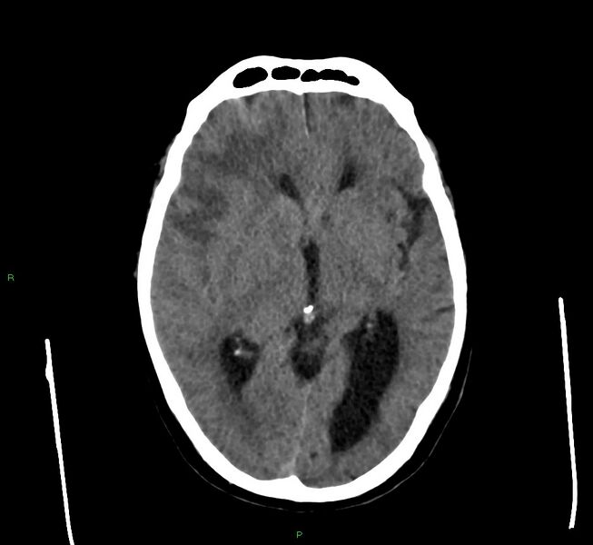 File:Cerebral amyloid angiopathy-associated lobar intracerebral hemorrhage (Radiopaedia 58560-65723 Axial non-contrast 30).jpg