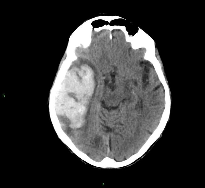 File:Cerebral amyloid angiopathy-associated lobar intracerebral hemorrhage (Radiopaedia 58758-65980 Axial non-contrast 30).jpg