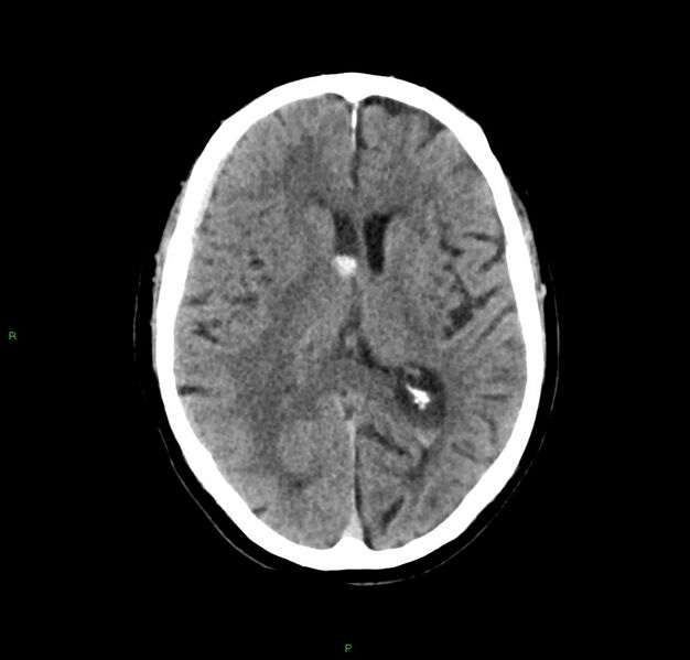 File:Cerebral amyloid angiopathy-associated lobar intracerebral hemorrhage (Radiopaedia 59356-66716 Axial non-contrast 23).jpg