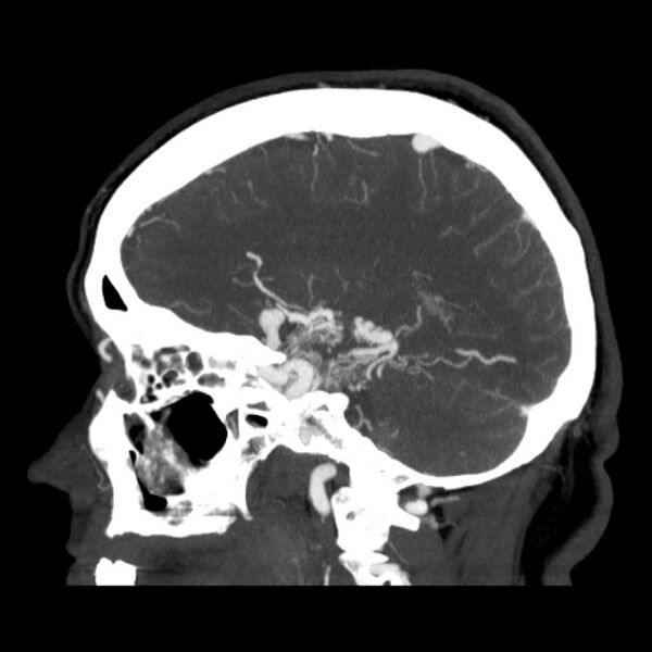 File:Cerebral arteriovenous malformation (Radiopaedia 43729-47189 D 32).jpg