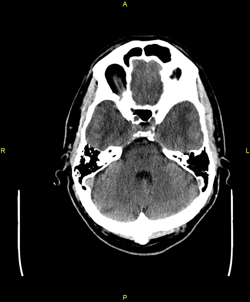 Cerebral autosomal dominant arteriopathy with subcortical infarcts and leukoencephalopathy (CADASIL) (Radiopaedia 86108-102051 Axial non-contrast 29).jpg