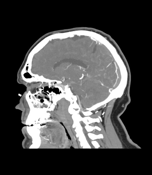 File:Cerebral dural venous sinus thrombosis (Radiopaedia 86514-102576 C 22).jpg