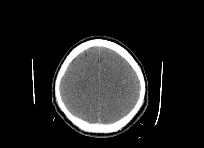 File:Cerebral edema (Radiopaedia 82519-96661 Axial non-contrast 15).jpg