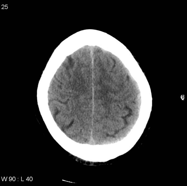 File:Cerebral hemorrhagic contusion with subdural and subarachnoid hemorrhage (Radiopaedia 10680-11146 Axial non-contrast 22).jpg