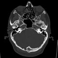 Cerebral hemorrhagic contusions (Radiopaedia 23145-23188 Axial bone window 12).jpg
