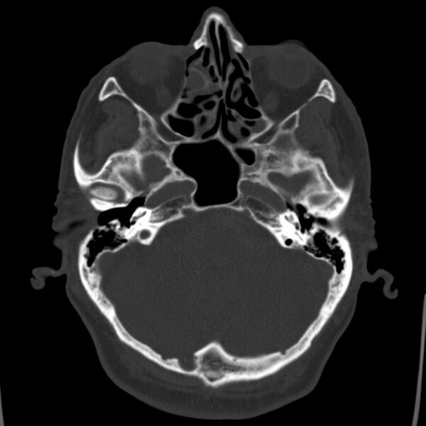 File:Cerebral hemorrhagic contusions (Radiopaedia 23145-23188 Axial bone window 12).jpg