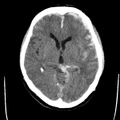 Cerebral hemorrhagic contusions (Radiopaedia 23145-23188 Axial non-contrast 18).jpg
