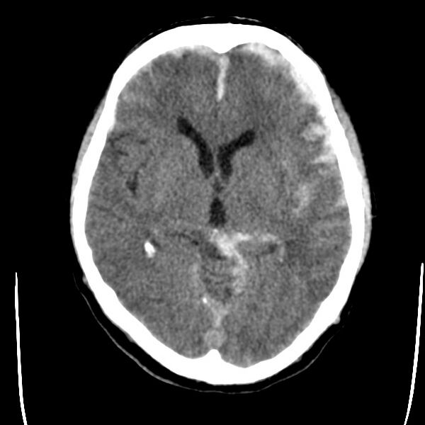 File:Cerebral hemorrhagic contusions (Radiopaedia 23145-23188 Axial non-contrast 18).jpg
