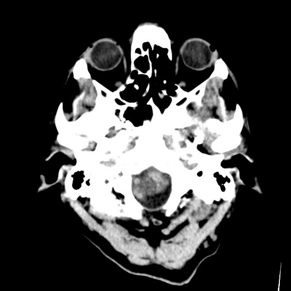 File:Cerebral hemorrhagic contusions (Radiopaedia 23145-23188 Axial non-contrast 2).jpg