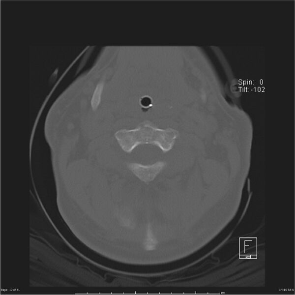 File:Cerebral hemorrhagic contusions and cervical spine fractures (Radiopaedia 32865-33841 C 10).jpg