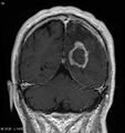Cerebral radiation necrosis (Radiopaedia 5665-7376 Coronal T1 C+ 1).jpg