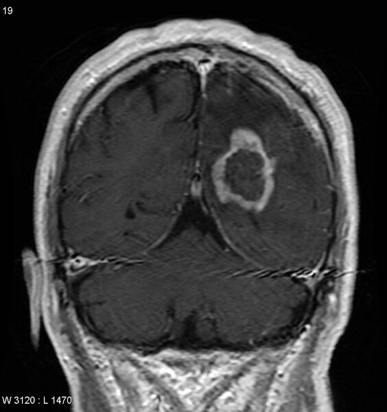 File:Cerebral radiation necrosis (Radiopaedia 5665-7376 Coronal T1 C+ 1).jpg