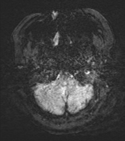 File:Cerebral venous infarct (Radiopaedia 53627-59685 Axial SWI 4).jpg
