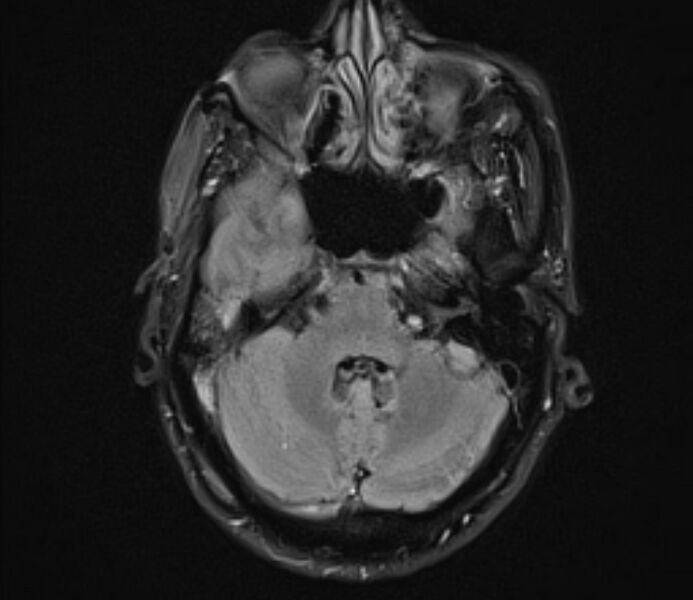 File:Cerebral venous thrombosis (Radiopaedia 71207-81504 Axial FLAIR 8).jpg