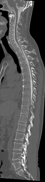 File:Cervical dural CSF leak on MRI and CT treated by blood patch (Radiopaedia 49748-54996 A 6).png