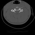 Cervical flexion teardrop fracture with cord hemorrhage (Radiopaedia 32497-33454 Axial bone window 40).jpg