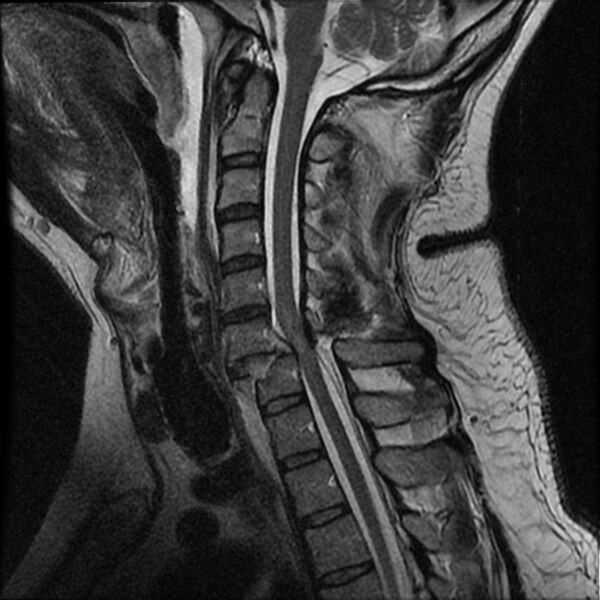 File:Cervical fracture and dislocation with locked facet (Radiopaedia 31837-32781 Sagittal T2 8).jpg