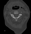 Cervical spine ACDF loosening (Radiopaedia 48998-54070 Axial bone window 21).png