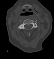 Cervical spine ACDF loosening (Radiopaedia 48998-54070 Axial bone window 24).png