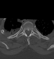 Cervical spine ACDF loosening (Radiopaedia 48998-54070 Axial bone window 61).png