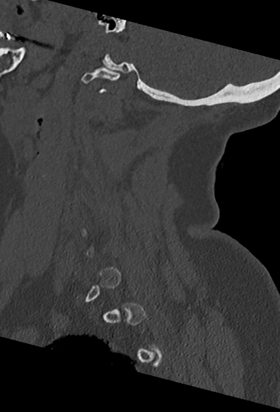 File:Cervical spine ACDF loosening (Radiopaedia 48998-54070 Sagittal bone window 26).png