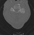 Cervical spondylolysis (Radiopaedia 49616-54811 Axial bone window 30).png