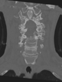 Cervical spondylolysis (Radiopaedia 49616-54811 Coronal bone window 19).png