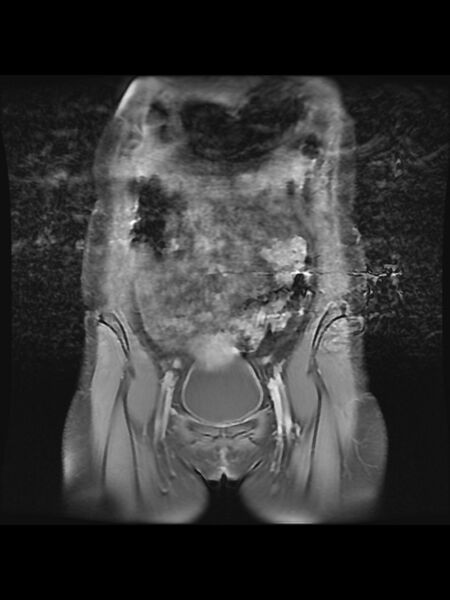 File:Cesarean section scar endometrioma (Radiopaedia 56569-63297 Coronal STIR 9).jpg