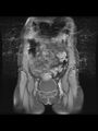 Cesarean section scar endometrioma (Radiopaedia 56569-63297 Coronal STIR 9).jpg