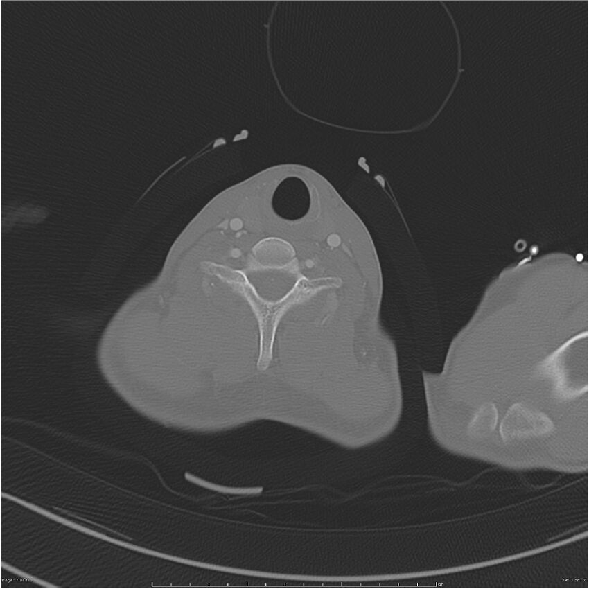 Chest and abdomen multi-trauma (Radiopaedia 26294-26425 bone window 1).jpg