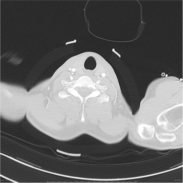 File:Chest and abdomen multi-trauma (Radiopaedia 26294-26425 lung window 4).jpg