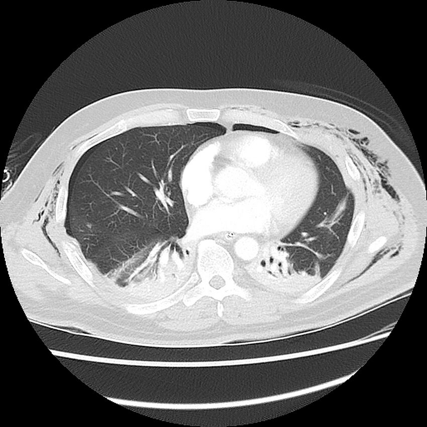 Chest crush injury (Radiopaedia 31620-32513 Axial lung window 34).jpg
