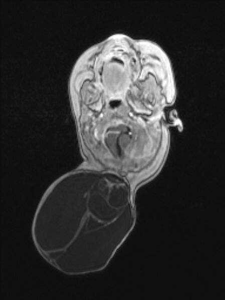 File:Chiari III malformation with occipital encephalocele (Radiopaedia 79446-92559 Axial T1 C+ mpr 30).jpg