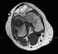 Chondroblastoma (Radiopaedia 11303-11667 Axial T1 1).jpg